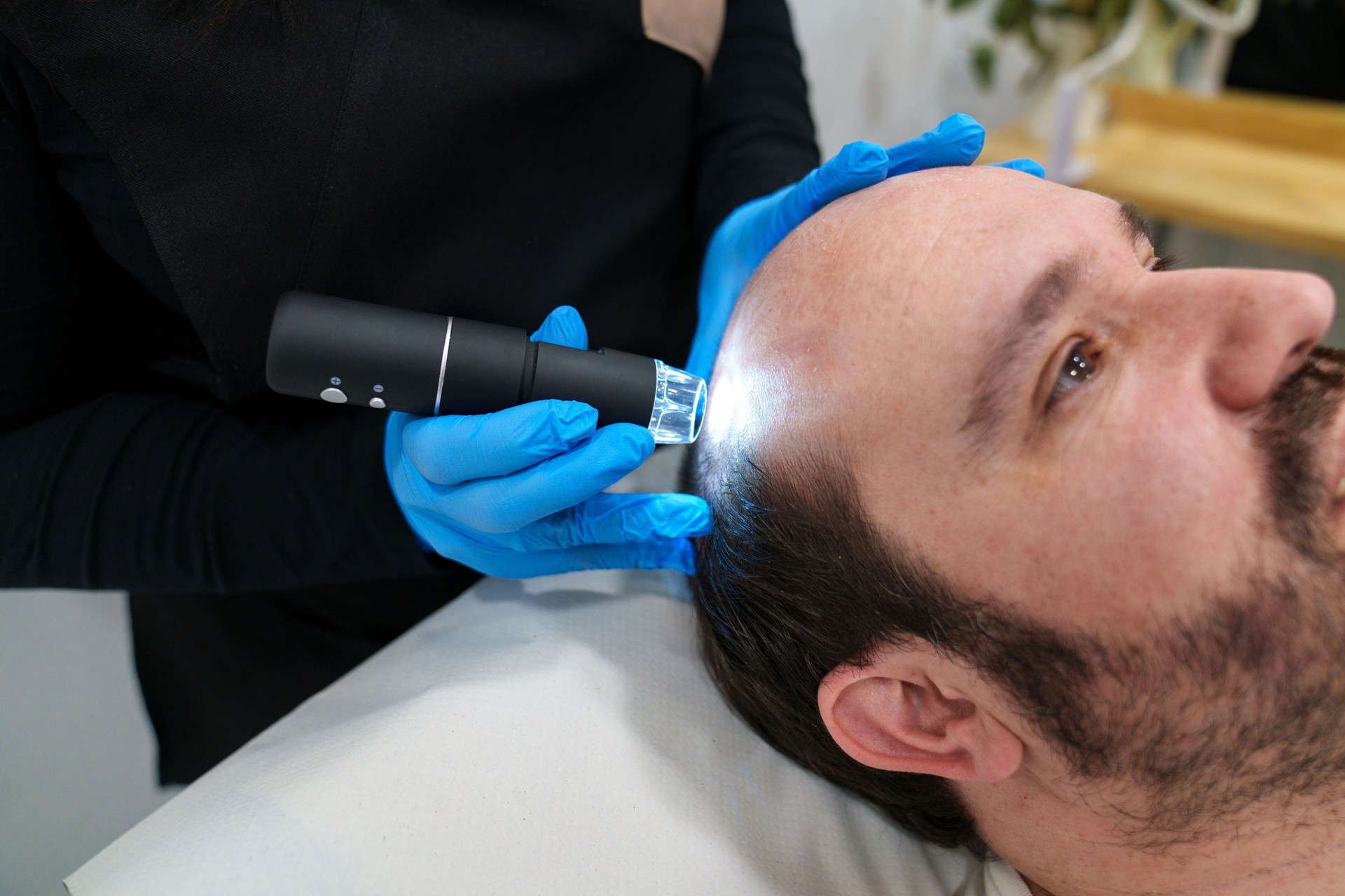 Hair Loss Treatment prp for hair, balding platelet rich plasma with microneedling leicester