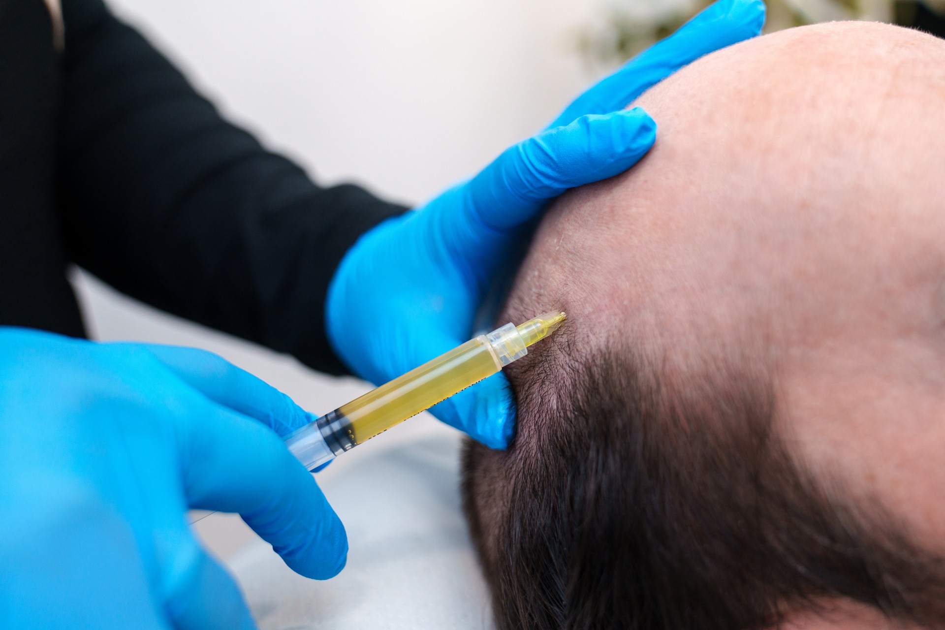 prp treatment therapy for hair loss leicester